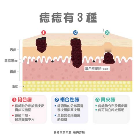 腹部長痣|痣變大、痣多或長毛會變皮膚癌？認識痣的形成與原因